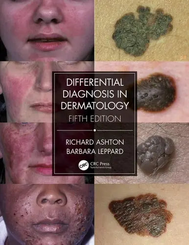 Differential Diagnosis in Dermatology by Richard Ashton 5th Edition ISBN 9780367085971